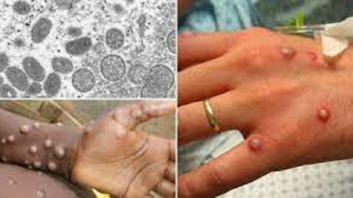 Virus cacar monyet atau monkeypox kini mudah bermutasi dan cepat sekali menular